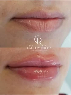 Prática de preenchimento facial em turma anterior