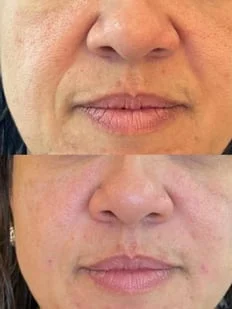 Prática de preenchimento facial em turma anterior